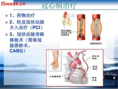 應(yīng)用在靜息心臟診斷冠狀動(dòng)脈狹窄的光纖壓力傳感器