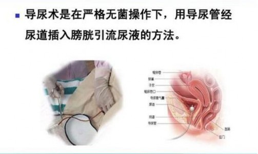 光纖壓力傳感器應(yīng)用于導(dǎo)尿管膀胱內(nèi)壓力監(jiān)控