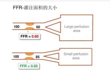 應(yīng)用在血流儲備分?jǐn)?shù)FFR系統(tǒng)中檢測壓力的光纖壓力傳感器